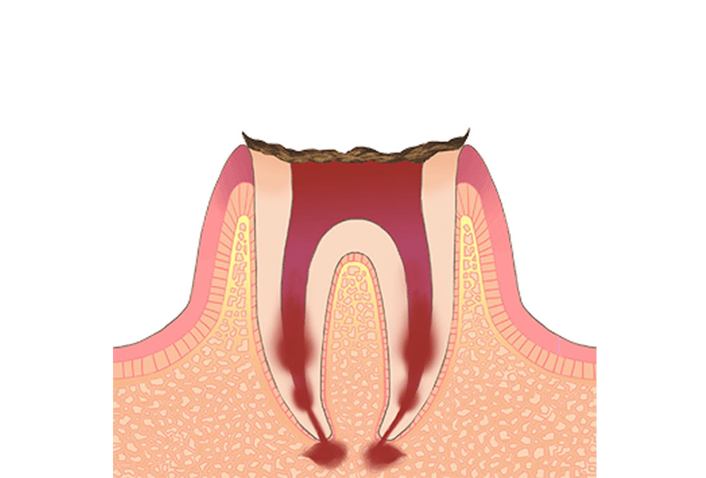 C4(歯の根だけが残っている状態の虫歯)